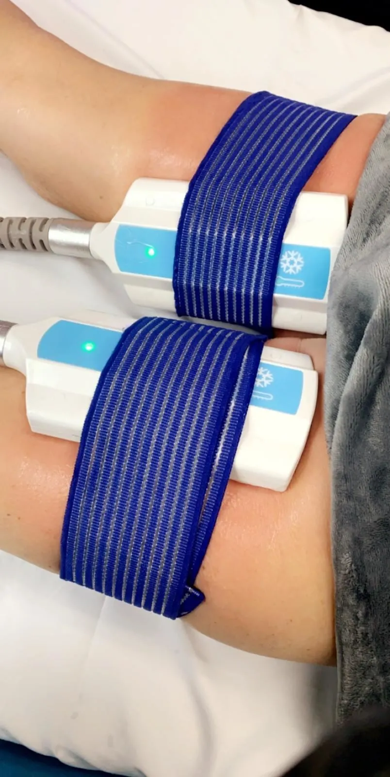 cryoskin static treatment